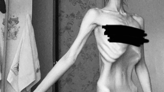 Мне чуть не сломали два зуба, когда хотели запихать перловую кашу