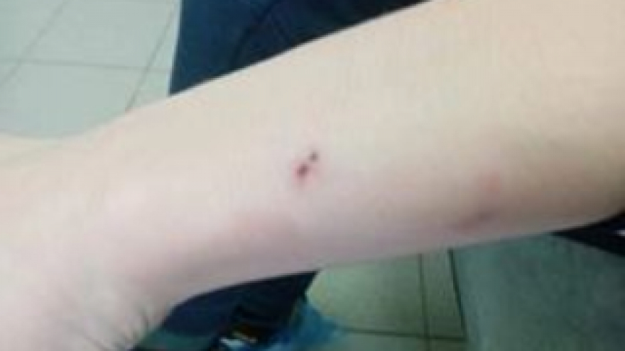 Очевидец: в Саратове собака укусила ребенка за руку