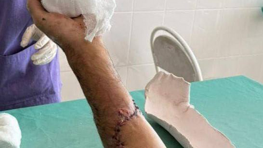 Саратовские врачи вернули мужчине руку после инцидента с бензопилой 