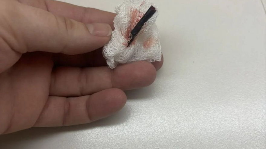 В Саратовской области врачи вытащили крупную щепку из руки мальчика