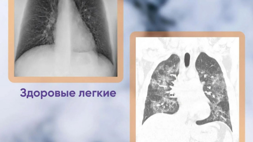 В Саратовской области юный курильщик вейпа лишился части легких