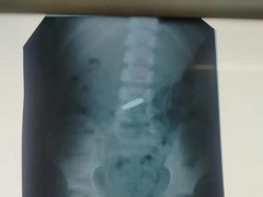 В Балакове врачи извлекли из желудка 4-летнего ребенка монету