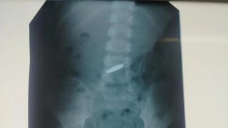 В Балакове врачи извлекли из желудка 4-летнего ребенка монету
