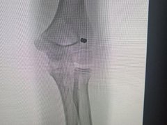 В Саратовской области у школьника из руки достали пулю