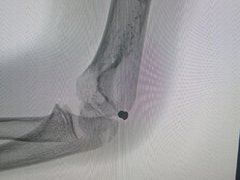 В Саратовской области у школьника из руки достали пулю